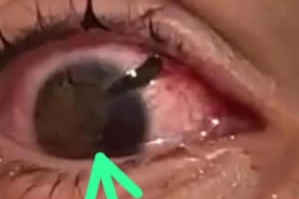 Estudante de 15 anos pode perder o olho após ‘brincadeira’ em sala de aula no interior